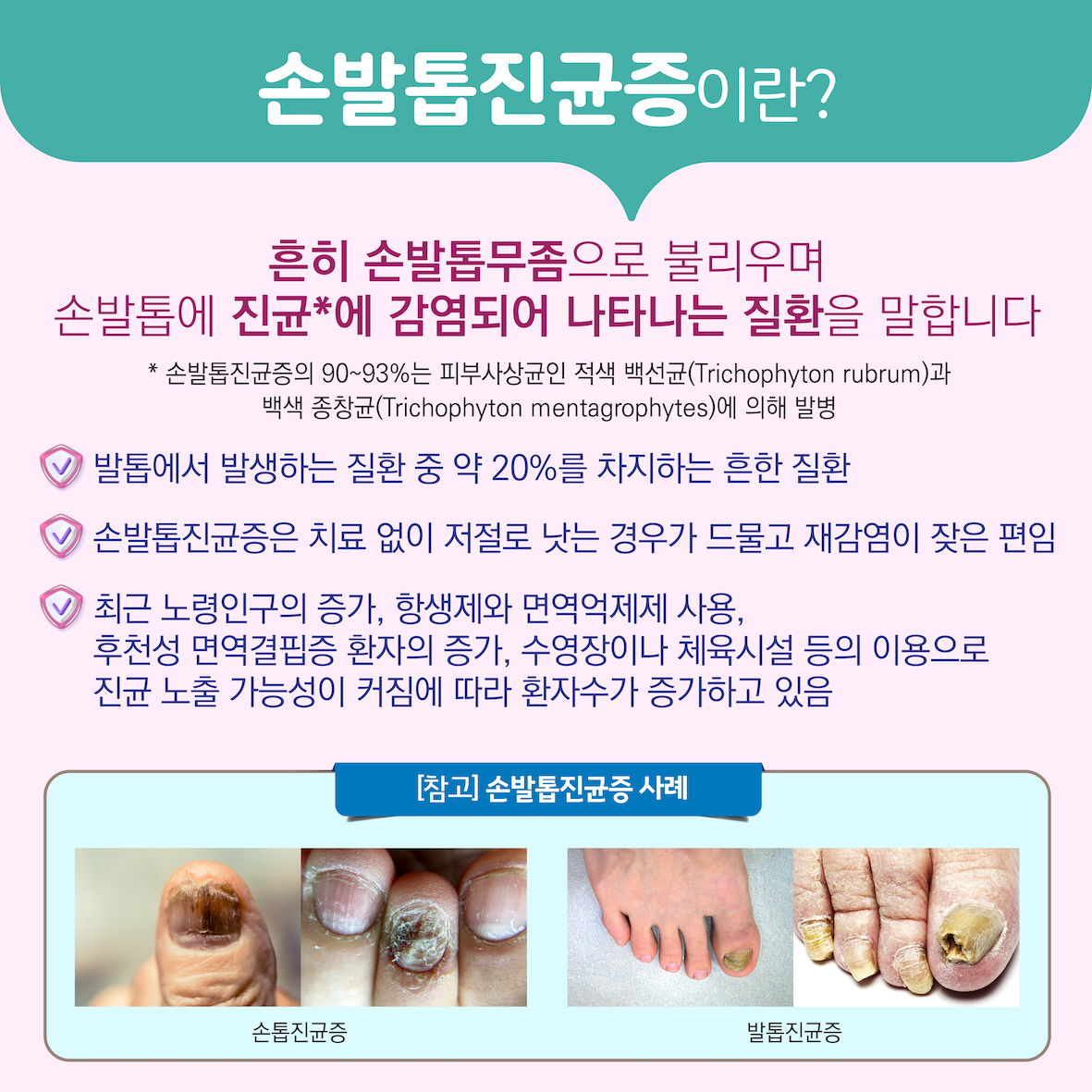 레이저를 이용한 손발톱진균증 치료술 이미지2