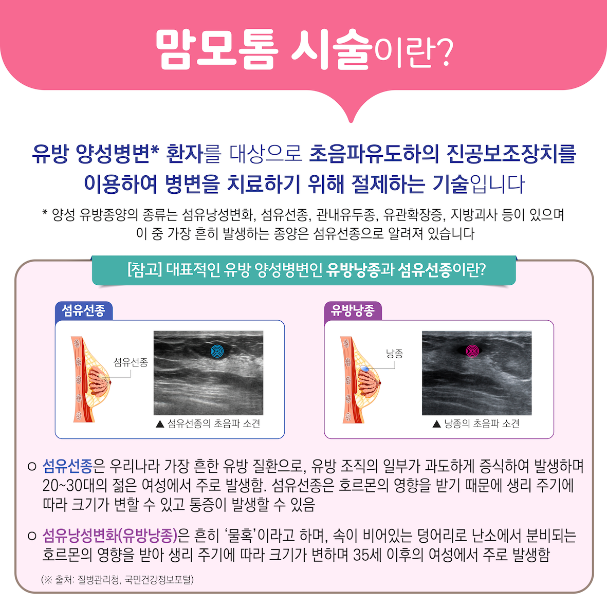 초음파 유도하의 진공보조장치를 이용한 유방 양성병변 절제술(맘모톰) 이미지2
