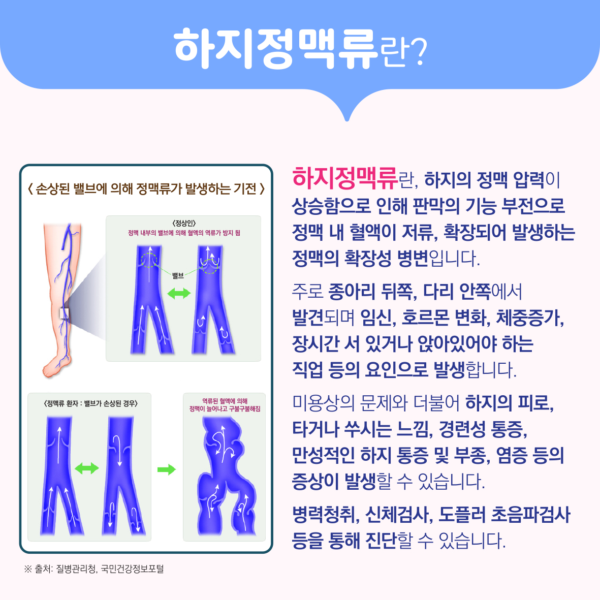 시아노아크릴레이트를 이용한 복재정맥 폐색술 이미지2