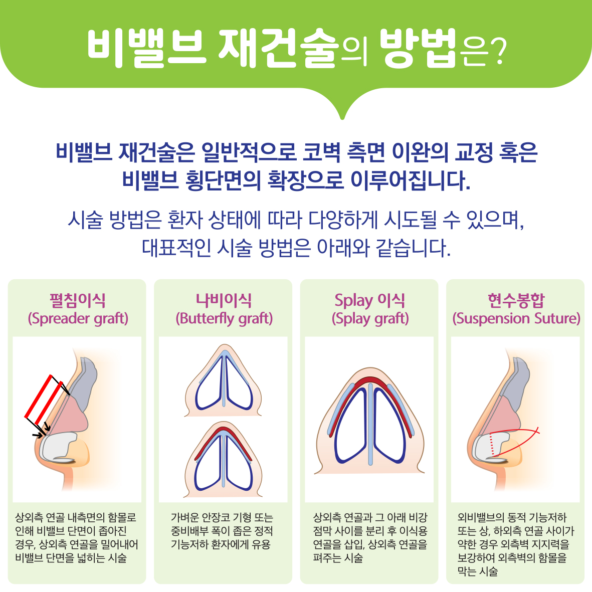 비밸브재건술 이미지4